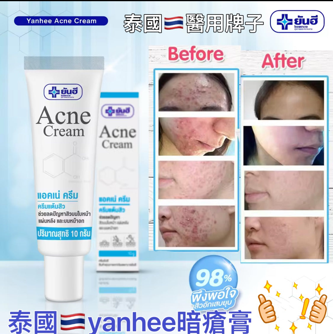 泰國🇹🇭yanhee 醫用 祛痘膏 針對暗瘡 痘痘 痤瘡問題的人