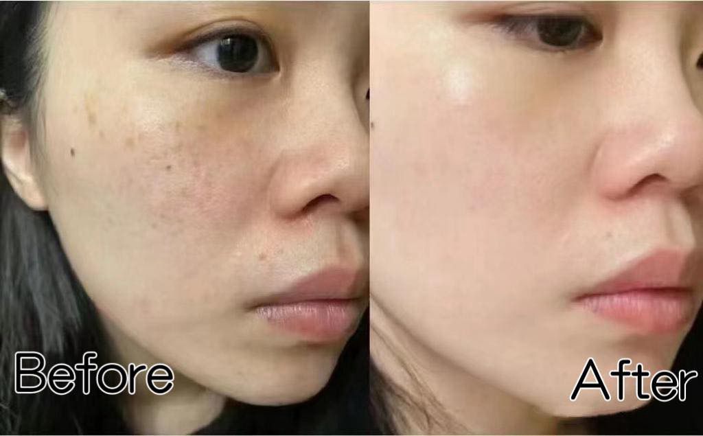 泰國🇹🇭超好用Yanhee針對斑 黑斑 黃褐斑霜