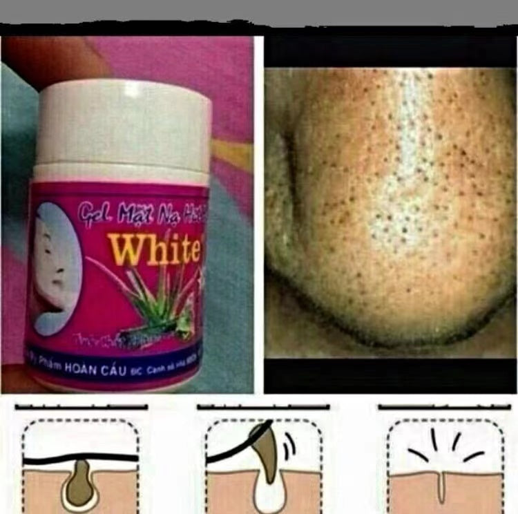 泰國快速🔜去黑頭水🍀