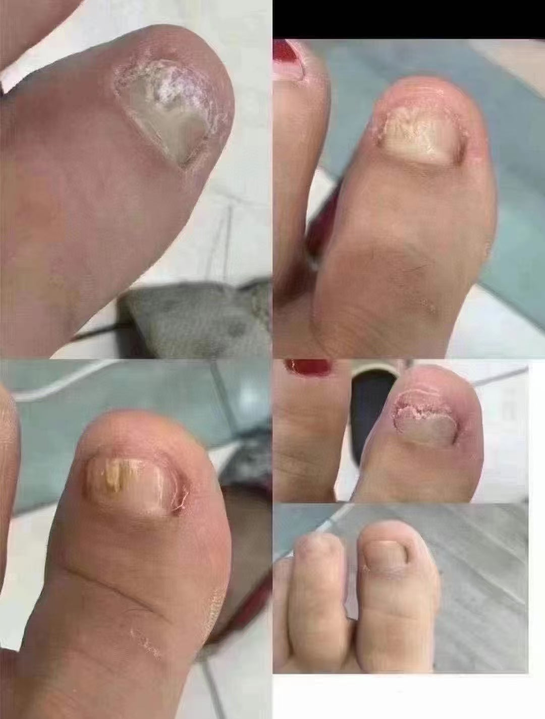 泰國高評價熱賣🔥強效去灰甲水,