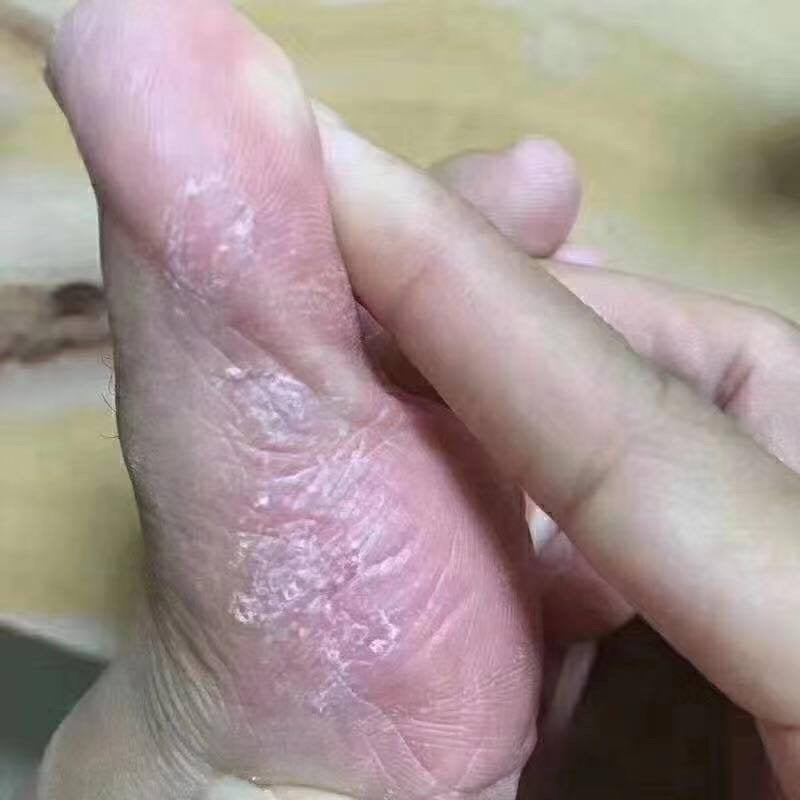 泰國🇹🇭用好的腳氣膏