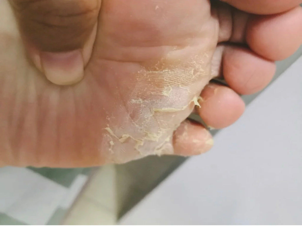 泰國🇹🇭用好的腳氣膏