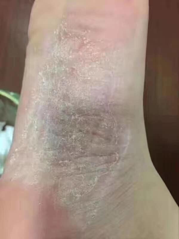 泰國🇹🇭用好的腳氣膏