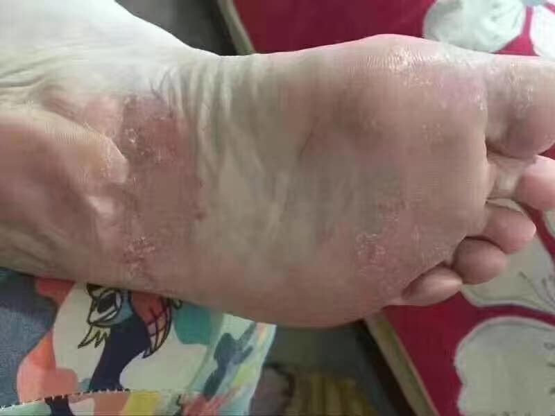 泰國🇹🇭用好的腳氣膏