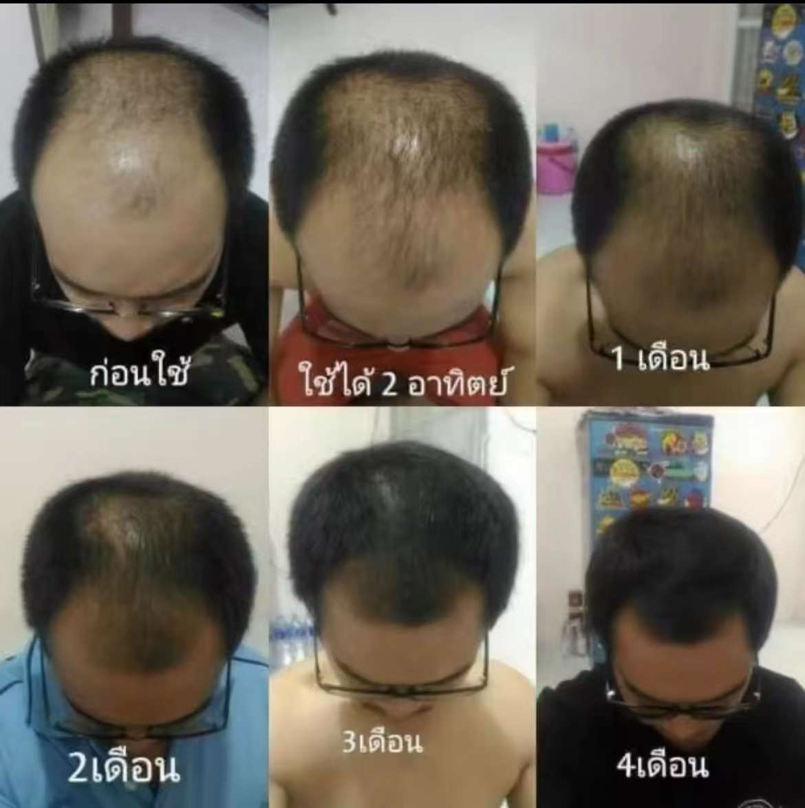 泰國🇹🇭Neo Hair 頭髮再生 生髮 防脫 營養液