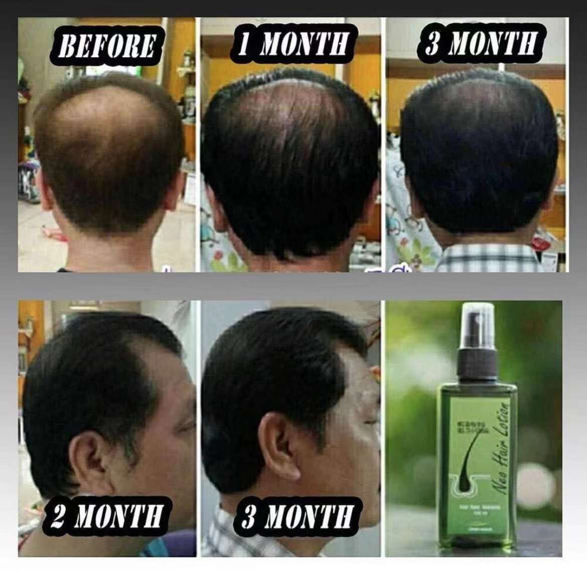 泰國🇹🇭Neo Hair 頭髮再生 生髮 防脫 營養液