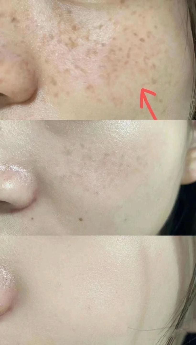 泰國🇹🇭超好用Yanhee針對斑 黑斑 黃褐斑霜