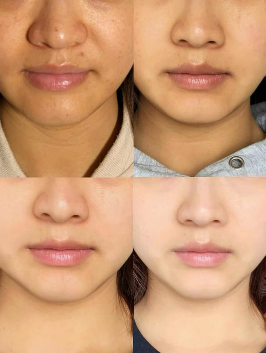 泰國🇹🇭yanhee醫用美白霜