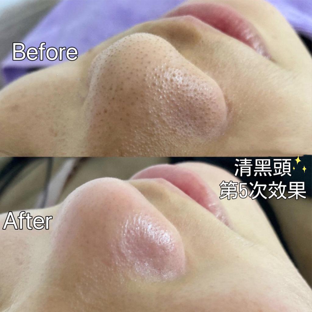 泰國🇹🇭OHO超強👍🏻清除黑頭收毛孔 磨砂粉（泰國熱銷🔥）掂👍🏻