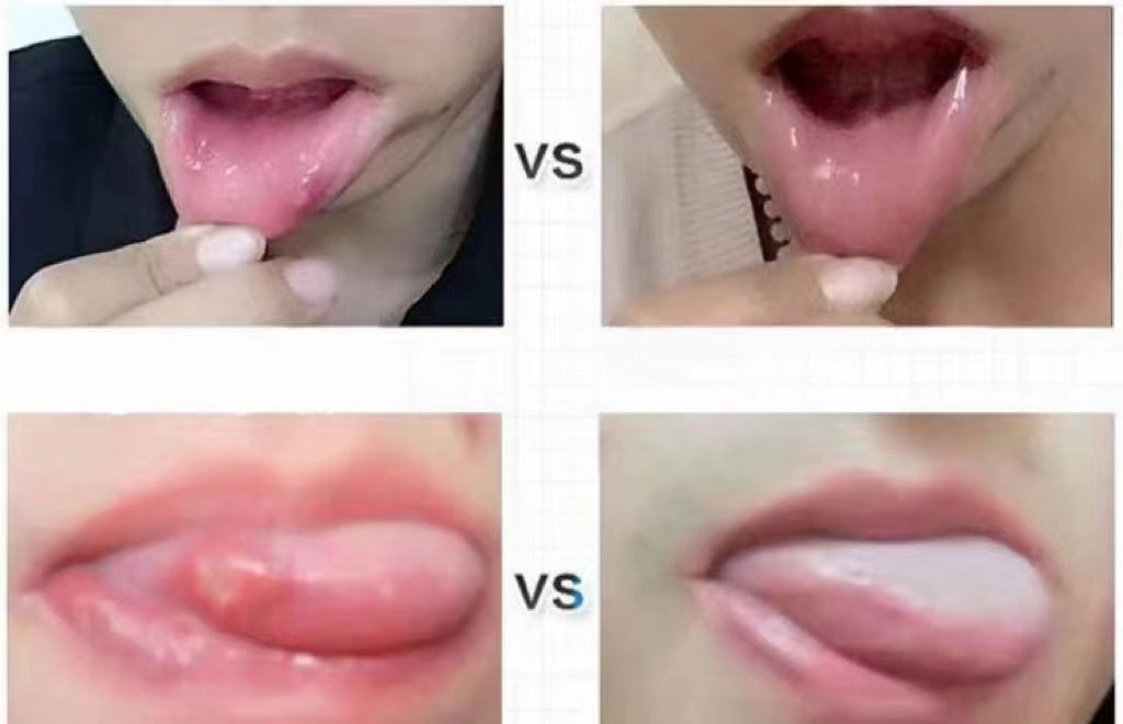 泰國🇹🇭NIDA 口腔潰瘍膏👍🏻必買 手信