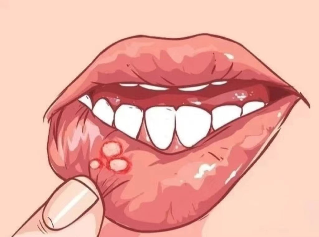 泰國🇹🇭NIDA 口腔潰瘍膏👍🏻必買 手信